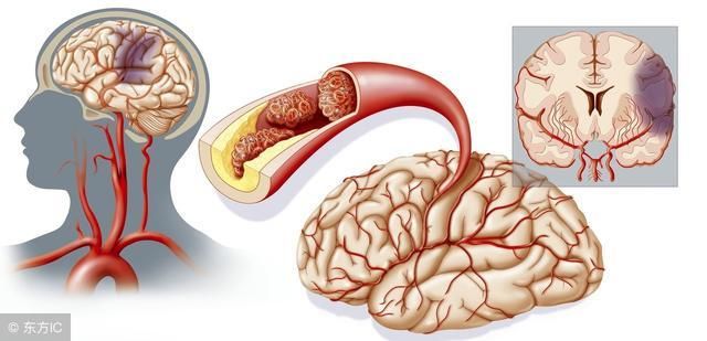 脑血栓的饮食有什么?脑血栓病人吃什么好呢
