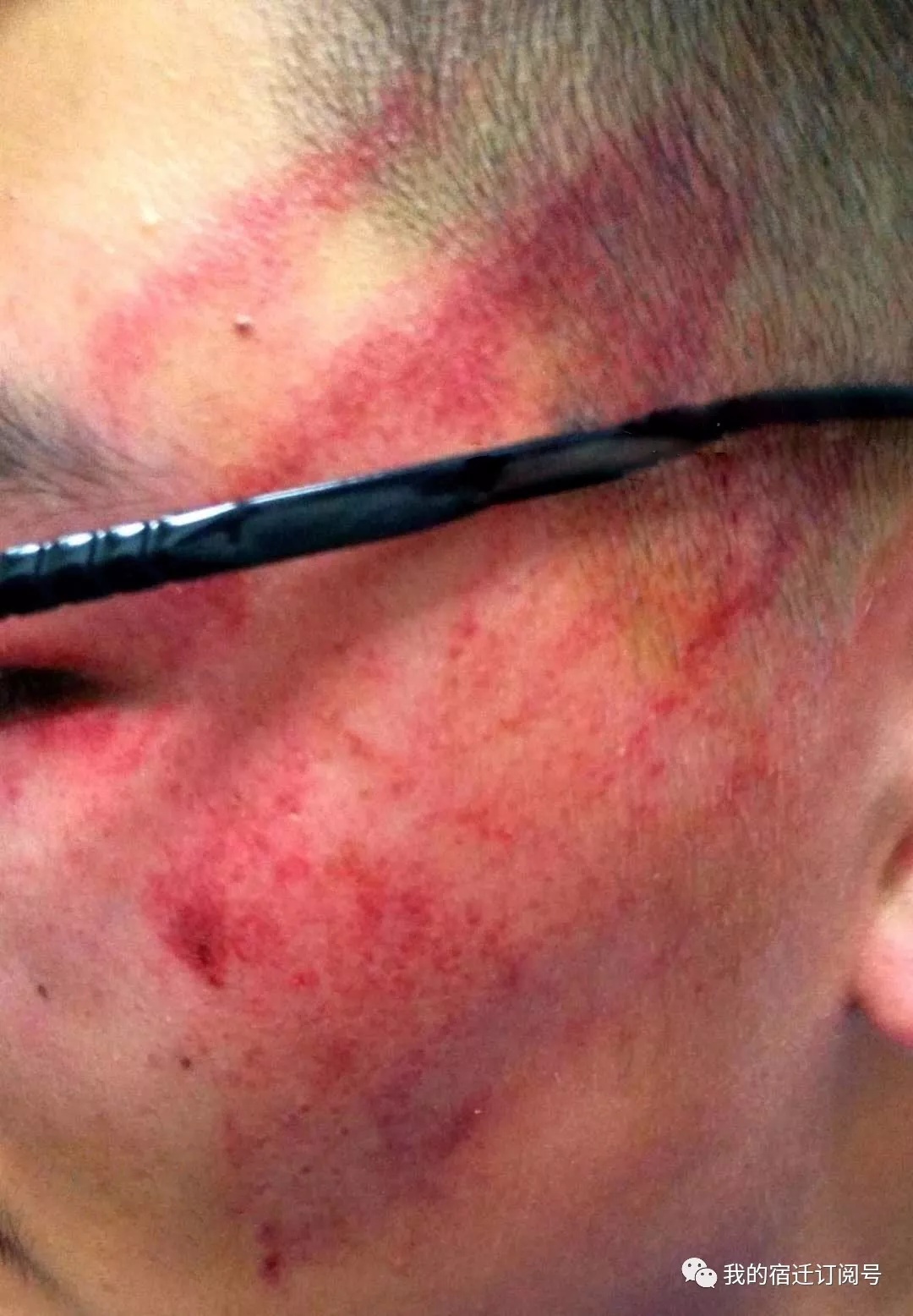 宿豫高中老师掌掴学生,致学生受伤住院!