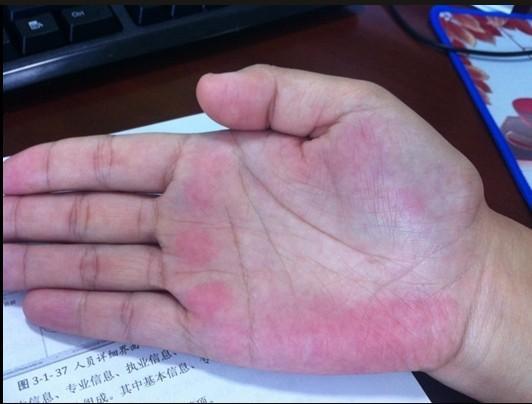 手掌充血发红,小心肝病肝掌,3种食物一吃立即