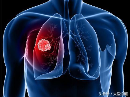 5个真实病例告诉你:这些癌症早期症状别忽视!