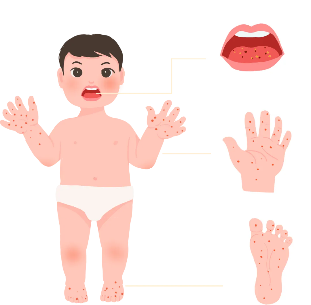 【疾控提醒】预防手足口病和疱疹性咽峡炎健康提示
