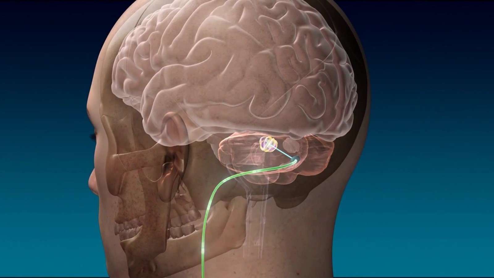 脑深部电刺激有助改善脑损伤后的上肢功能 脑深部电刺激有助改善脑损伤后的上肢功能