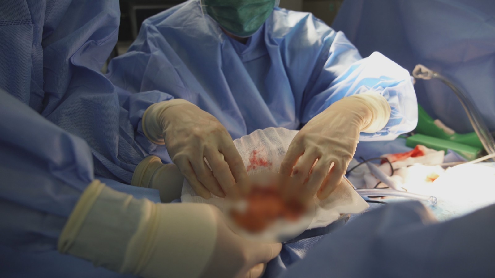 曾经植入奥美定患者应定期检查尽快取出