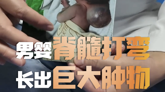 耀耀因脊髓打弯长巨大肿物，病情危重影响四肢和呼吸