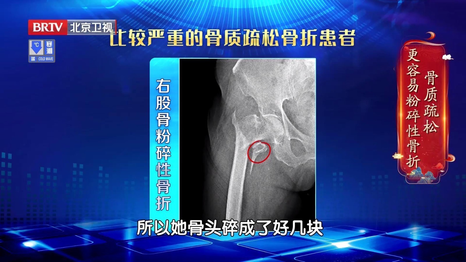 骨质疏松的骨头，远比您想象的还要脆弱！