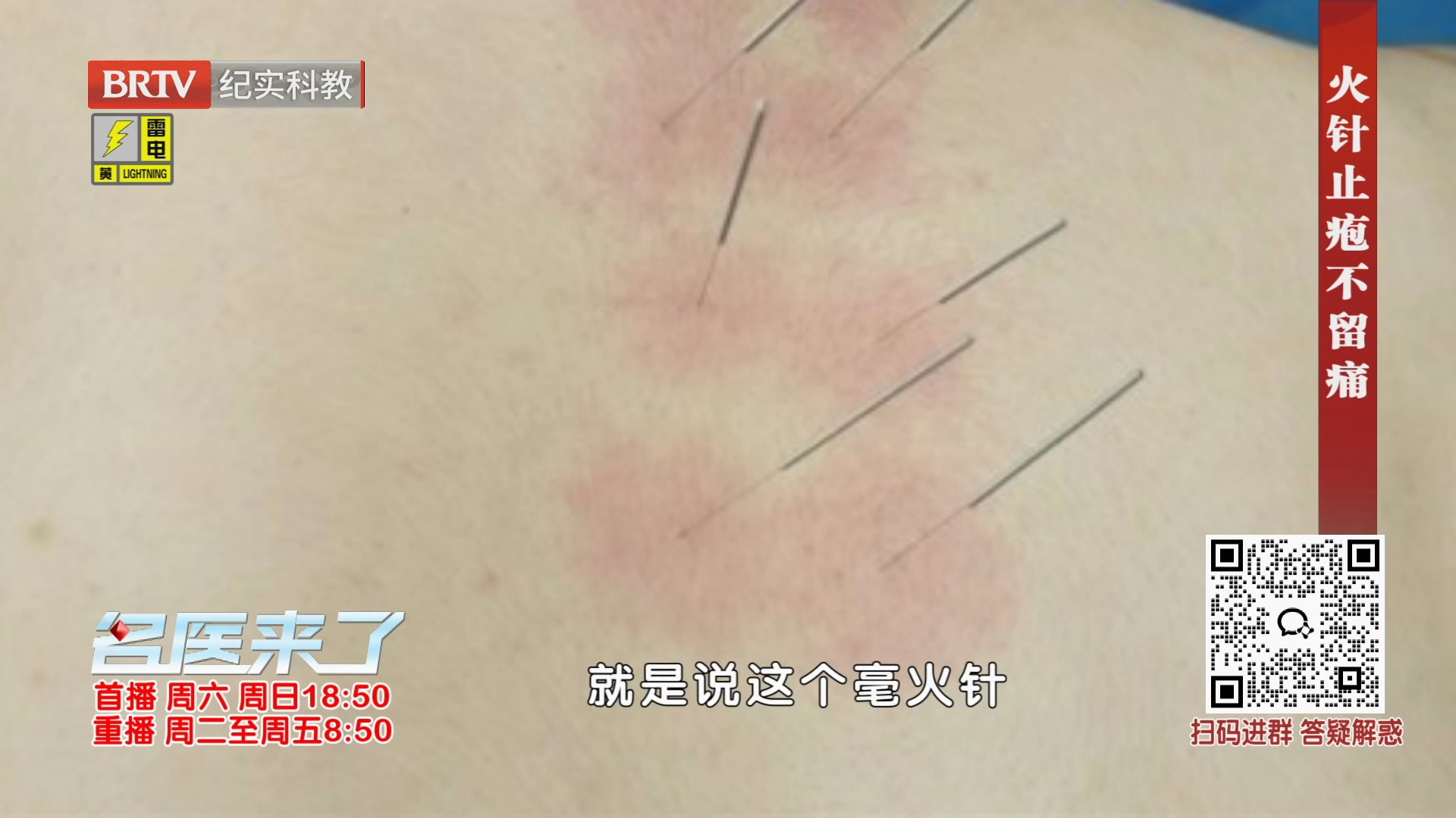 《名医来了》20260801火针止疱不留痛