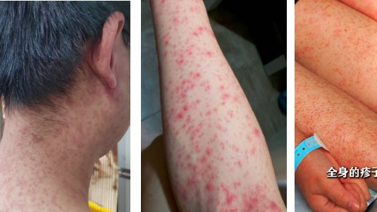 广东佛山一区发布基孔肯雅热后遗症告知书