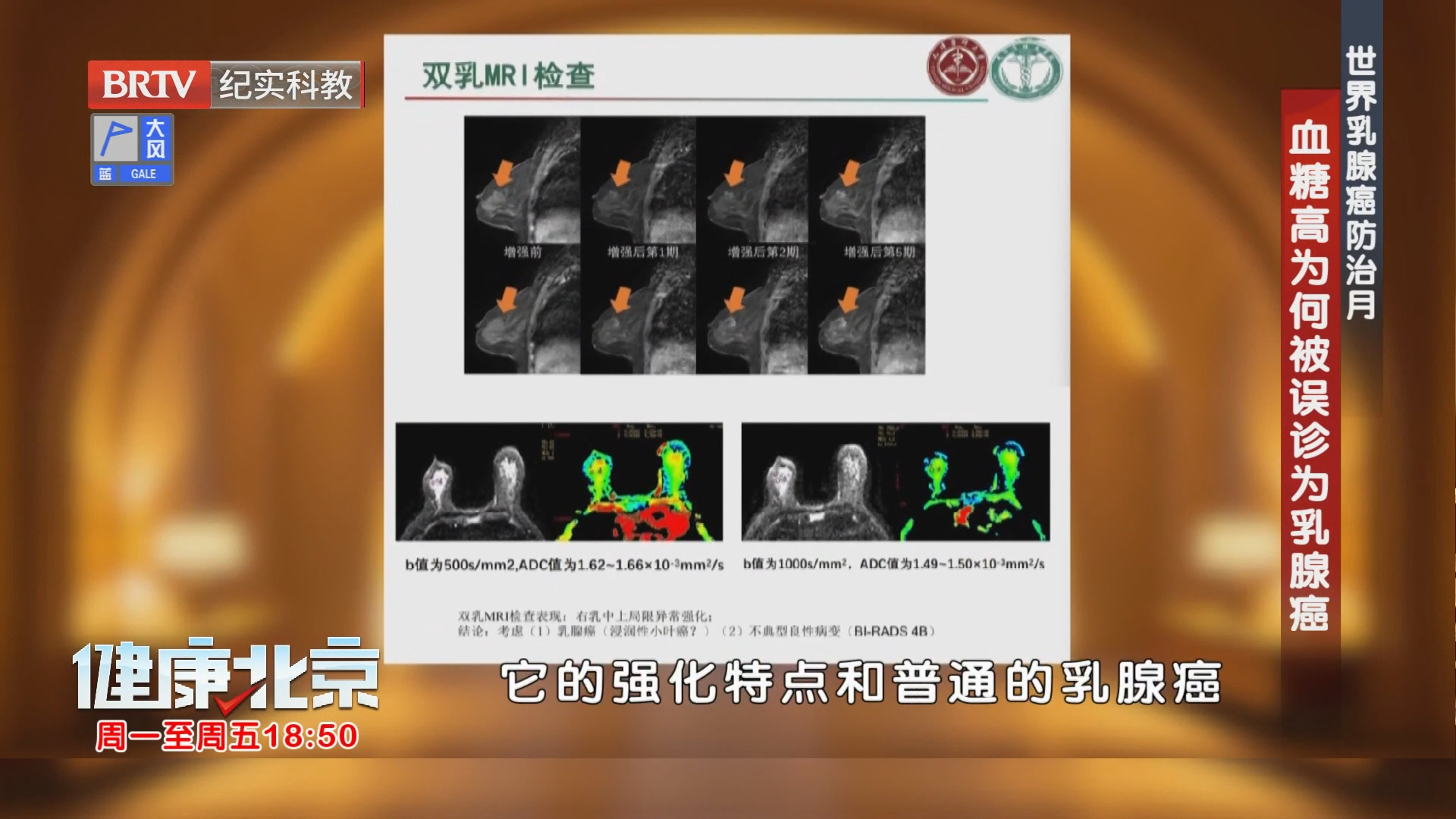 血糖高为何被误诊为乳腺癌