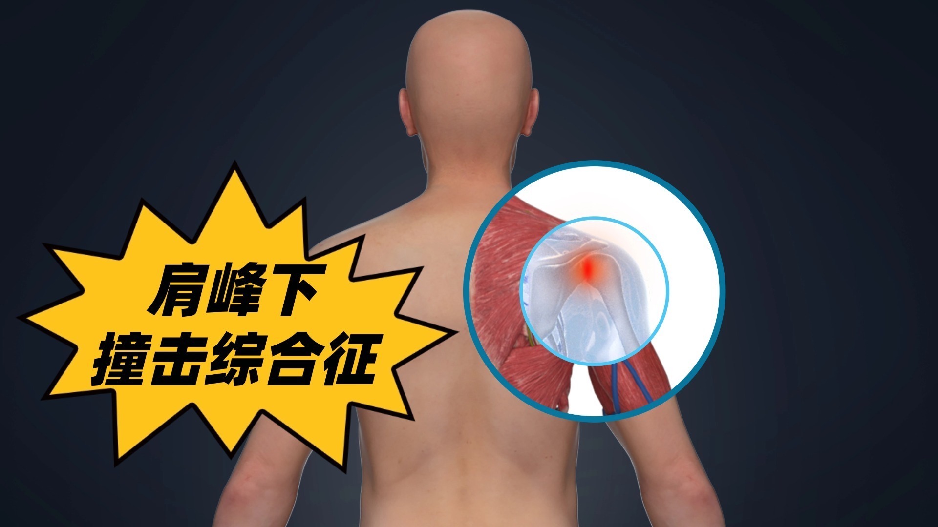 肩痛久治不愈 竟与胸椎有关