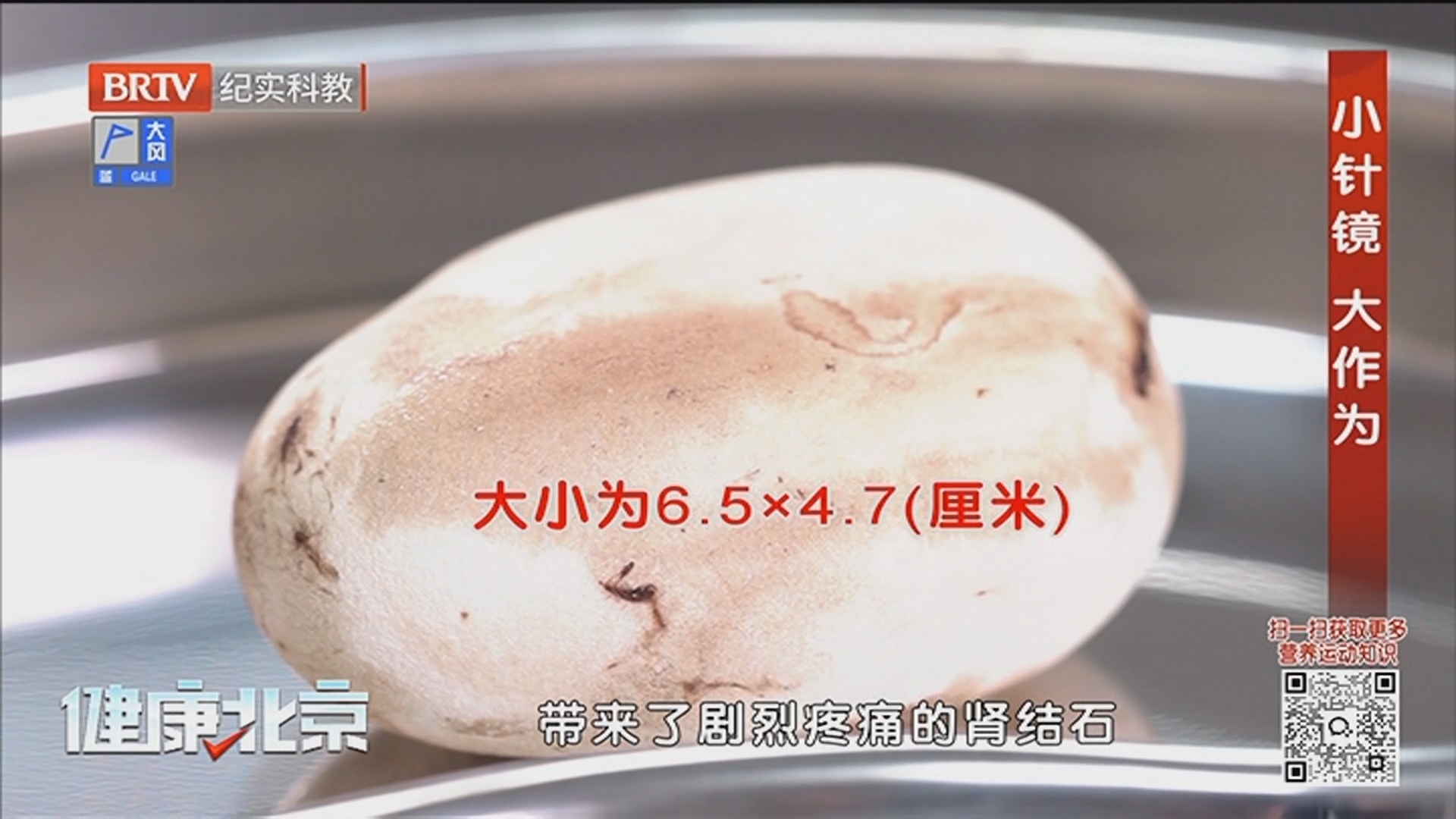 《健康北京》20250422小针镜 大作为