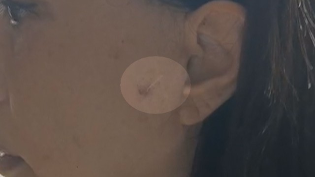 线雕手术三年后脸上钻出一根线！四次病历均写着可吸收线