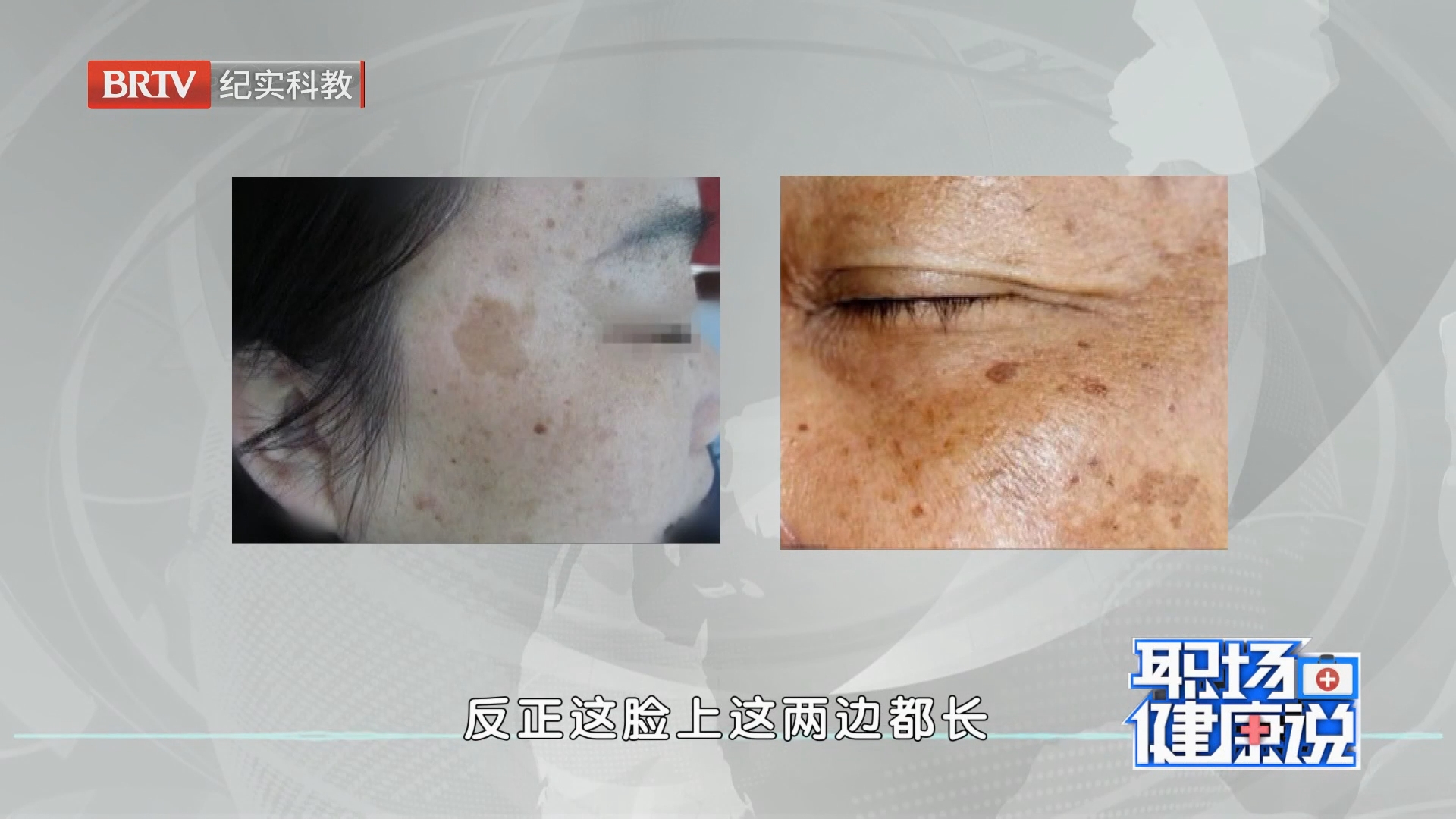 《职场健康说》20260825藏于斑下的“隐患”