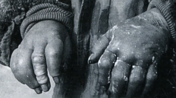 视频丨“光着身子,零下25摄氏度……” 731部队原成员亲述冻伤实验细节 视频丨“光着身子,零下25摄氏度……” 731部队原成员亲述冻伤实验细节