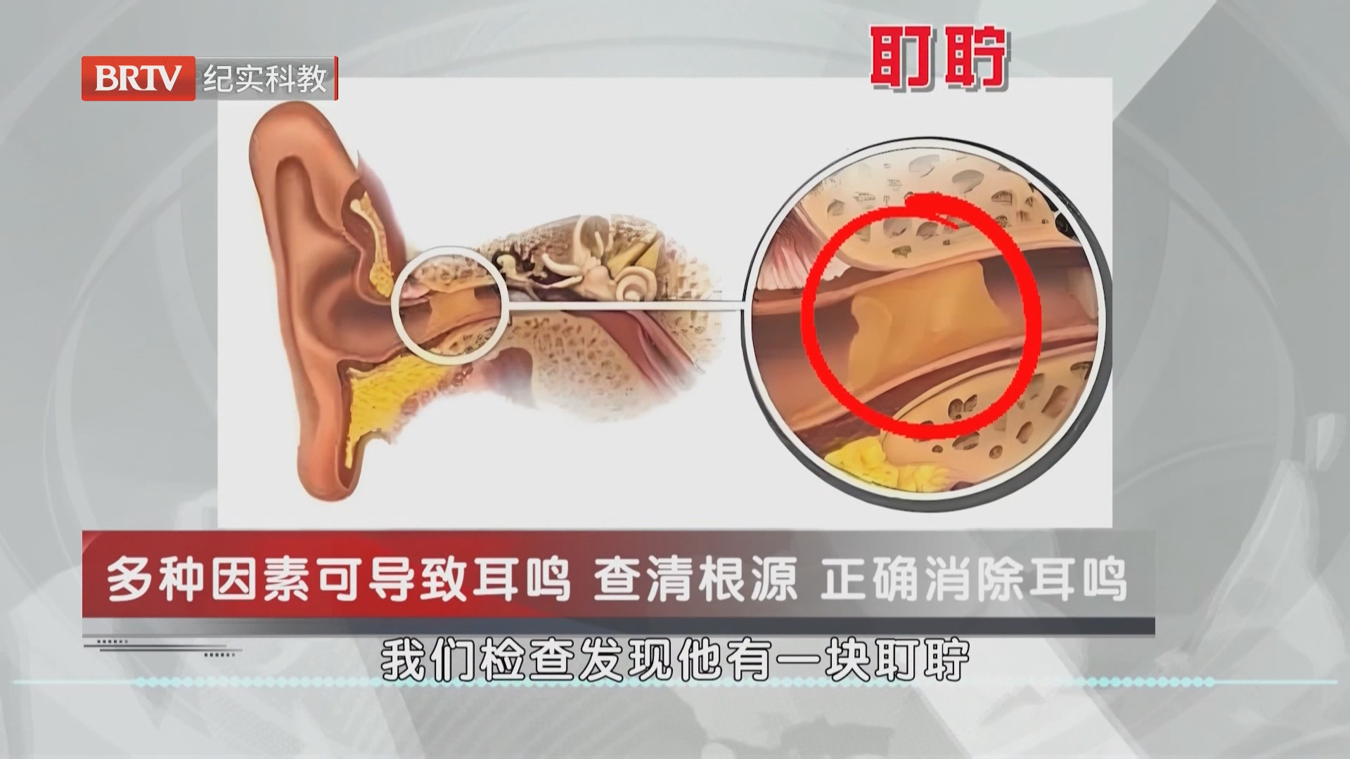 《职场健康说》20261029永不消逝的噪音 耳鸣 《职场健康说》20261029永不消逝的噪音 耳鸣