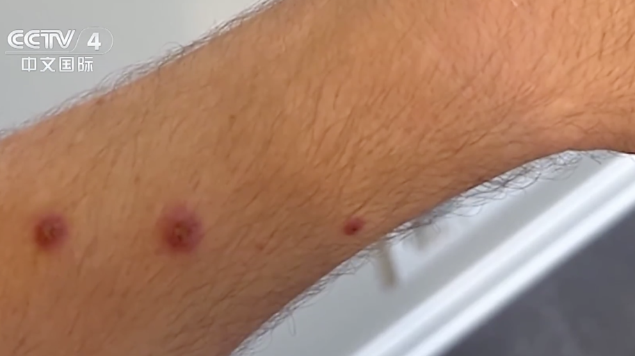 亚洲首例！猴痘变异新毒株出现，可飞沫传播，世卫组织启动全球计划！