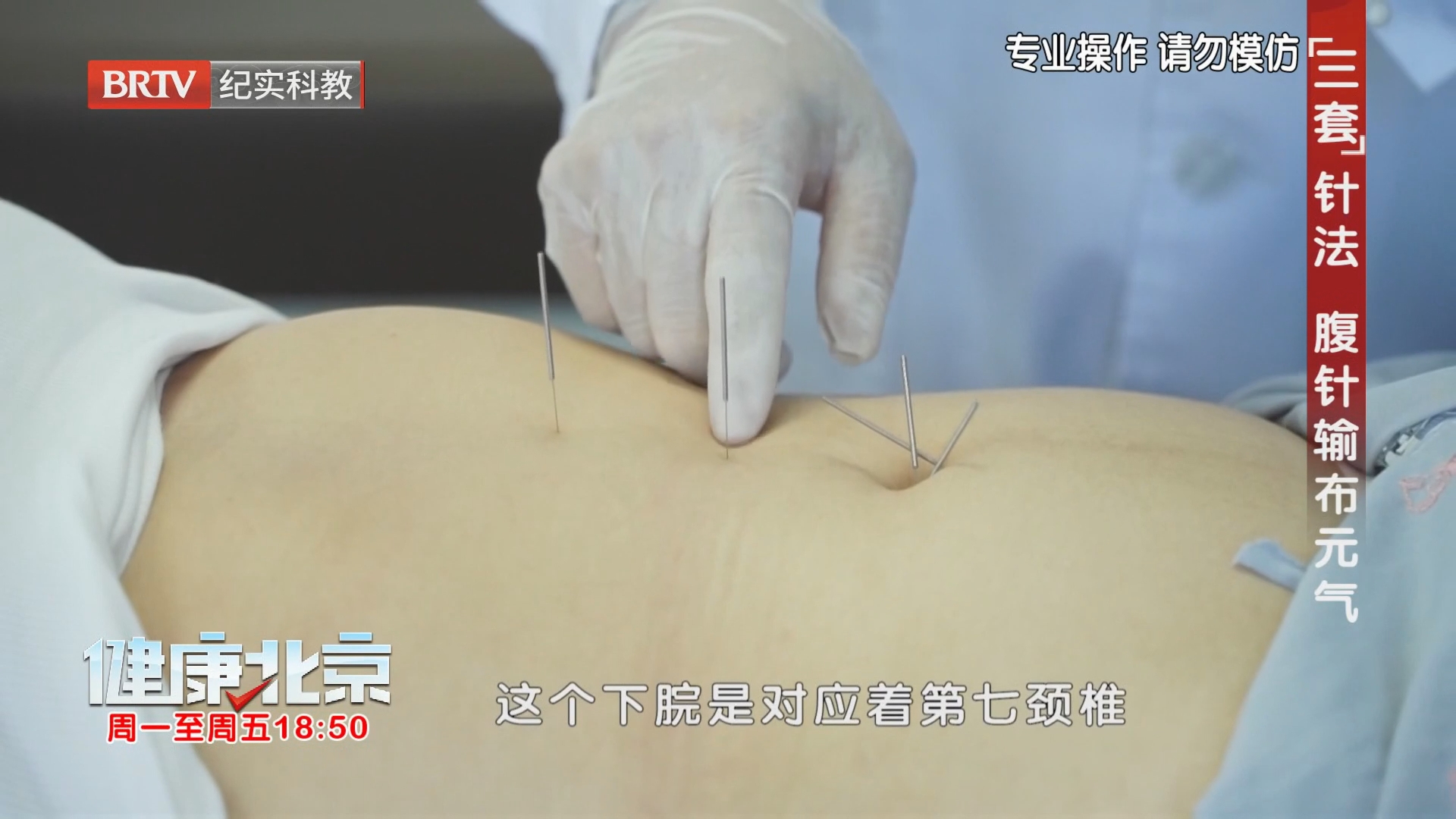 “三套”针法 腹针输布元气