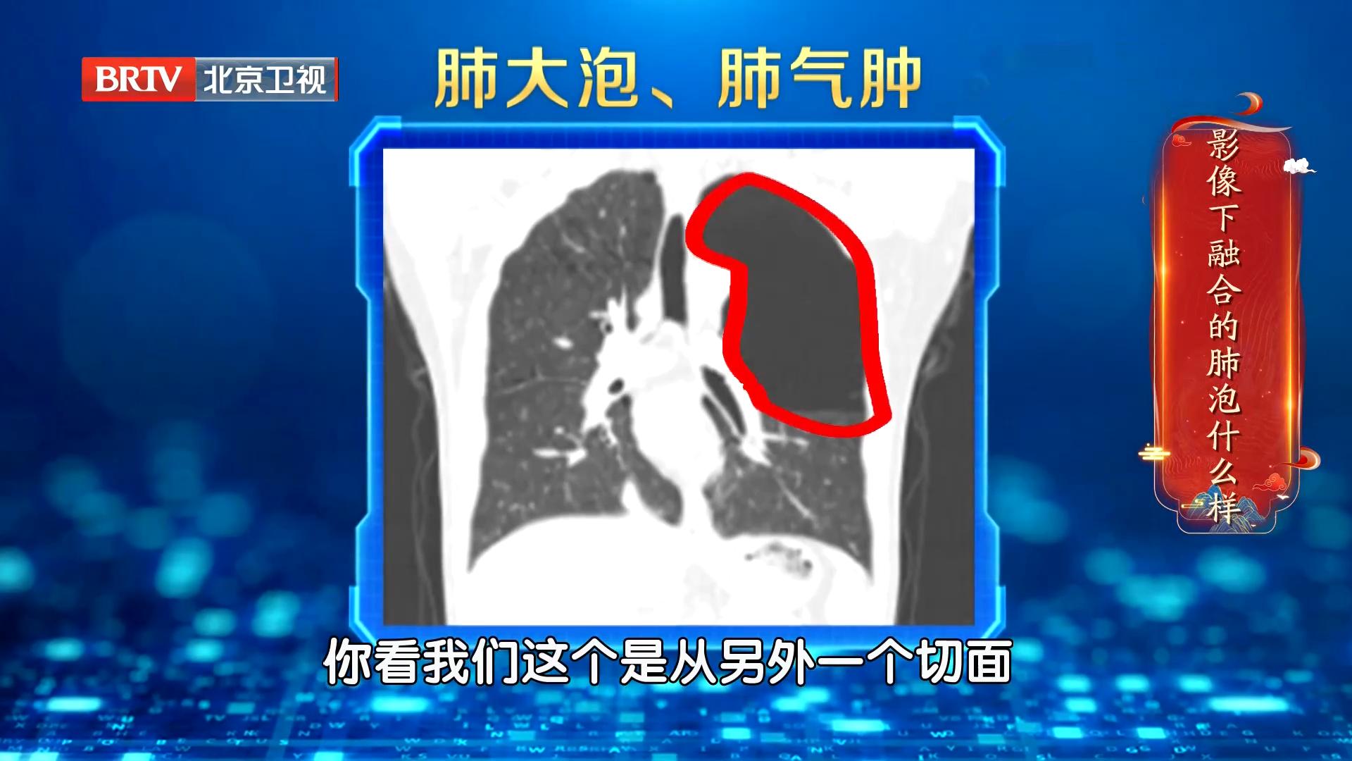 找不同！CT影像下融合的肺泡是什么样的？