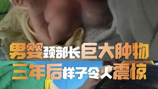 十几天男婴颈部竟长出半个头大肿物，三年后的样子让所有人震惊！