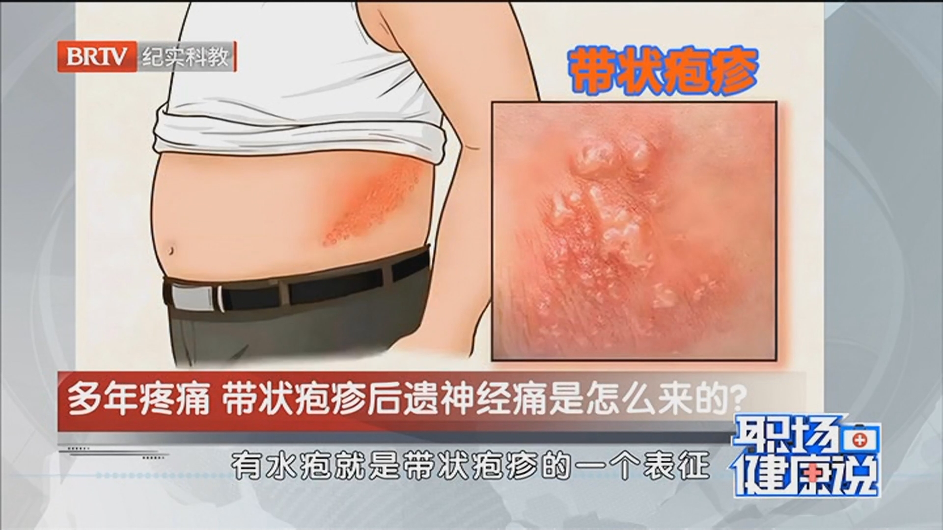 《职场健康说》20260401多年疼痛 带状疱疹后遗神经痛是怎么来的？